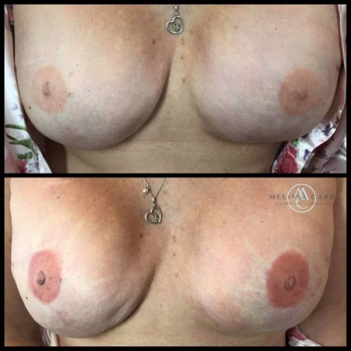 3D-Medical-Tattooing-Nipple-Areola-Breast-Tattooing-Melissa-Carr-Cosmetic-Tattooing
