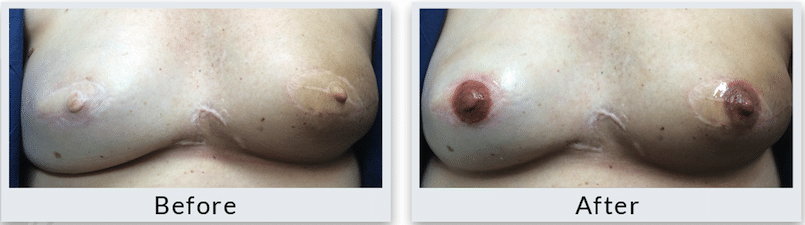 Areola Size adjusment