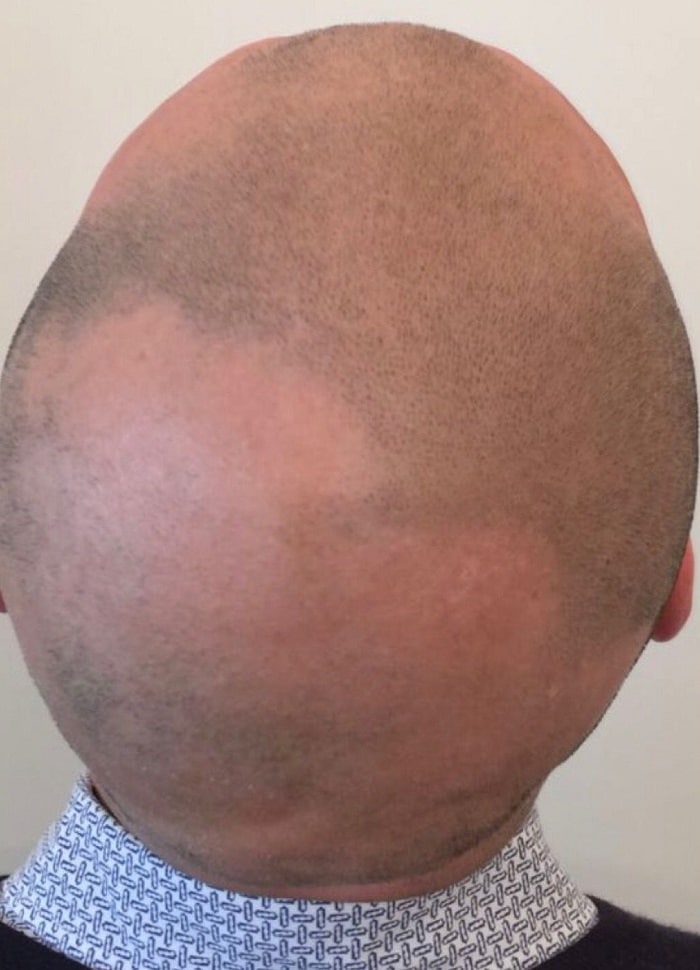 smp alopecia before