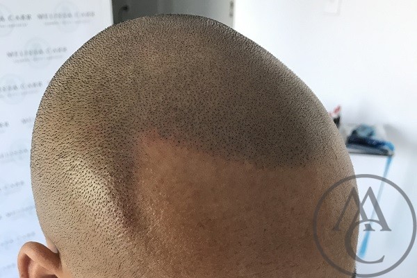 scalp micropigmentation scalp micropigmentation